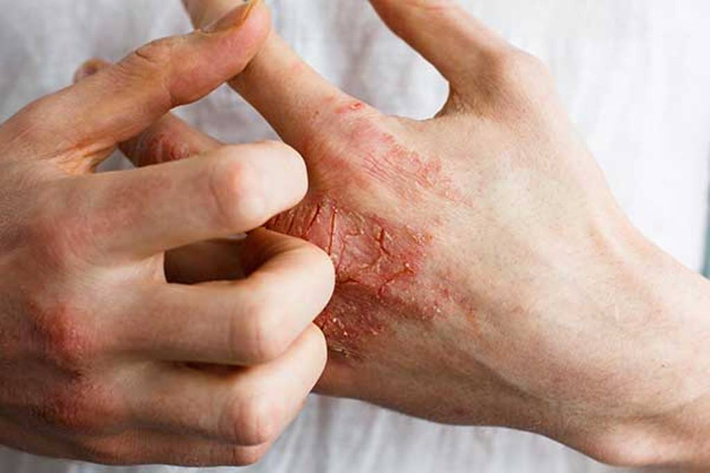 Potential to Treat Eczema and Psoriasis