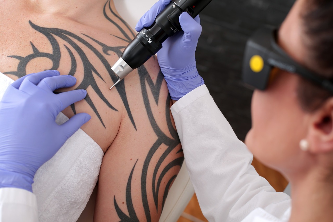 What Skin Tattoo Removal Works Best On
