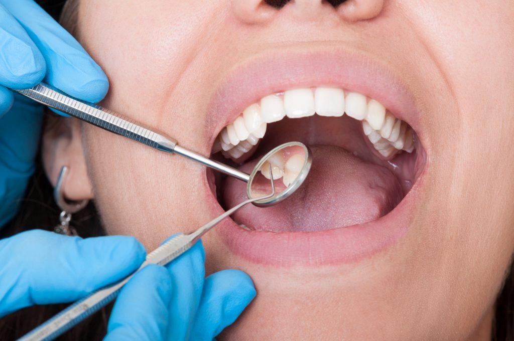 Why Do Dental Infections Happen