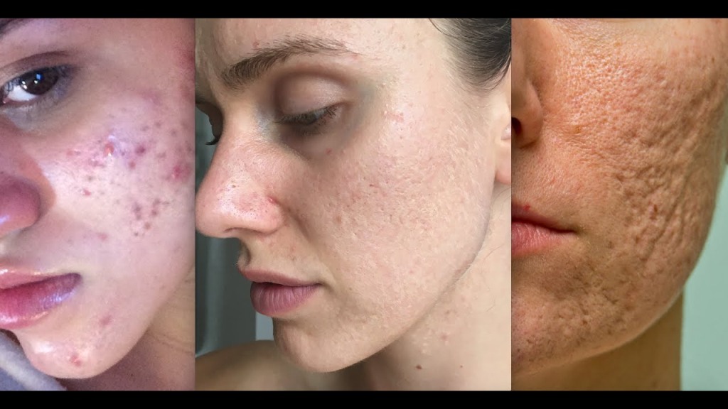 7 Best Acne Scar Treatments Recommended by Dermatologists - Available Ideas