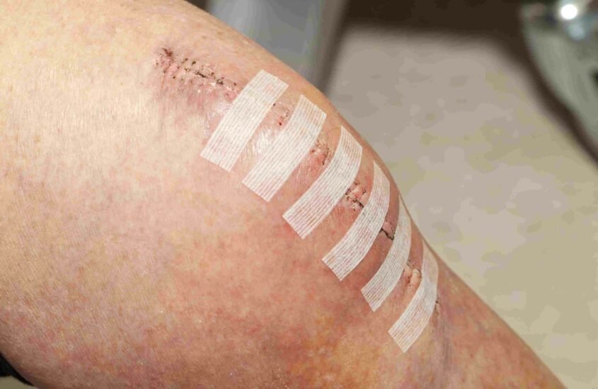 post-surgery-wound-care-wound-care-guide-available-ideas